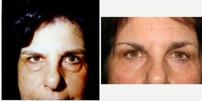 Eyelid Surgery before and after photo