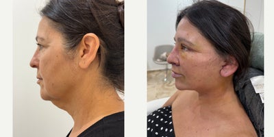 Neck Lift before and after photo
