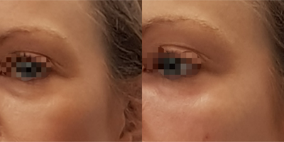 Eyelid Surgery before and after photo
