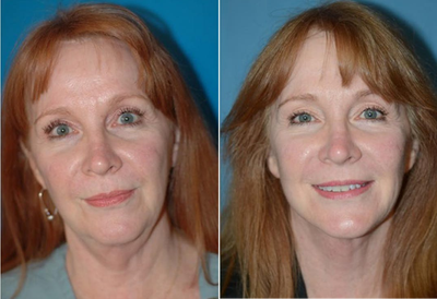 Facelift before and after photo