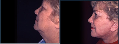 Facelift before and after photo