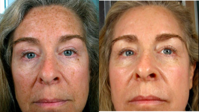 Laser Resurfacing before and after photo