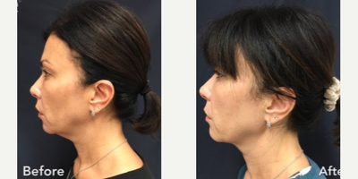 PrecisionTx before and after photo