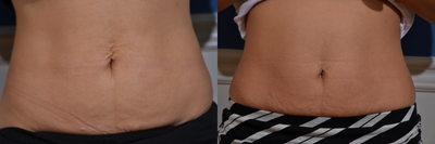Skin Rejuvenation before and after photo