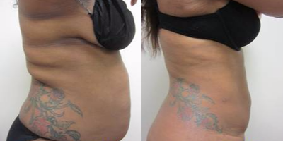 SlimLipo before and after photo