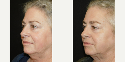 CoolSculpting before and after photo