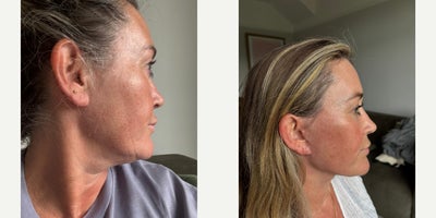 Deep Plane Facelift before and after photo