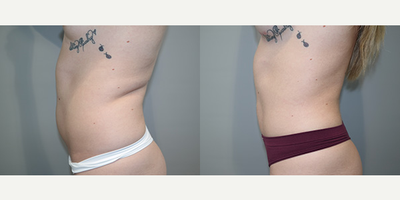Liposuction before and after photo