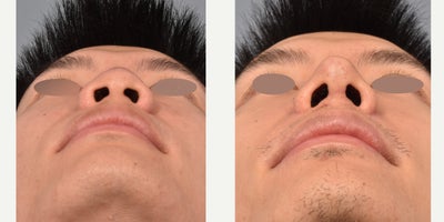 Asian Rhinoplasty before and after photo