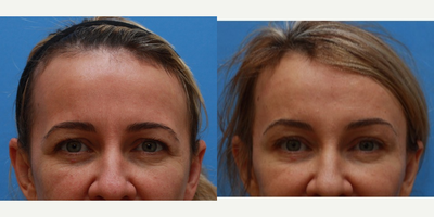 Brow Lift before and after photo