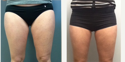 CoolSculpting before and after photo