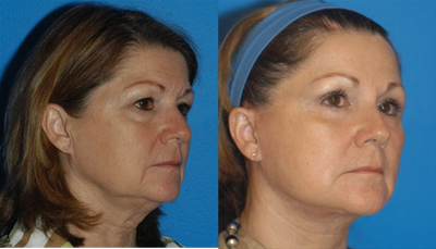 Facelift before and after photo