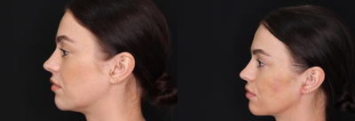 Juvederm before and after photo