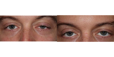 Ptosis Surgery before and after photo