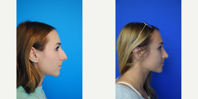 Septoplasty before and after photo