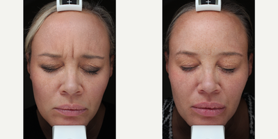 Botox before and after photo
