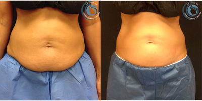 CoolSculpting before and after photo