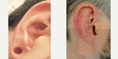 Earlobe Repair before and after photo