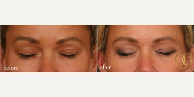 Eyelid Surgery before and after photo