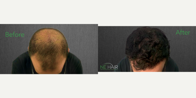 FUE Hair Transplant before and after photo
