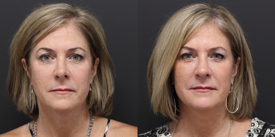 Revision Rhinoplasty before and after photo