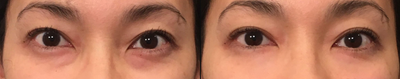 Voluma before and after photo