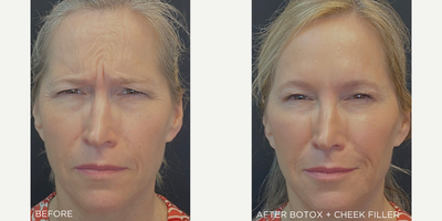 Botox before and after photo