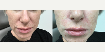 Dermal Fillers before and after photo