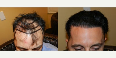 FUE Hair Transplant before and after photo