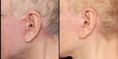 Laser Resurfacing before and after photo