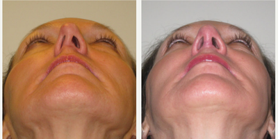 Rhinoplasty before and after photo