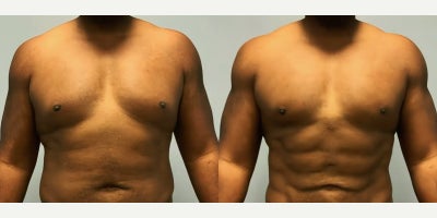 Vaser Liposuction before and after photo