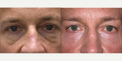 Belotero before and after photo