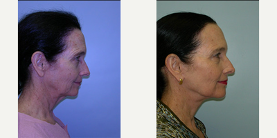 Neck Lift before and after photo