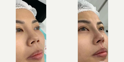 Dermal Fillers before and after photo