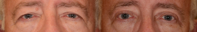 Eyelid Surgery before and after photo