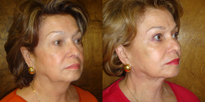 Facelift before and after photo