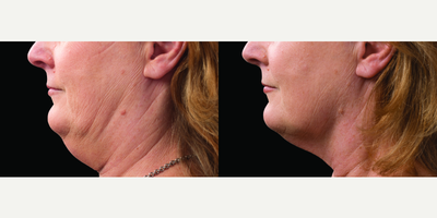 CoolSculpting before and after photo