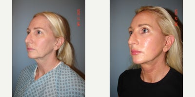 Deep Plane Facelift before and after photo