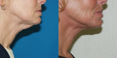 Neck Lift before and after photo