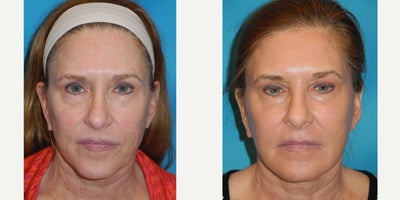 CO2 Laser before and after photo