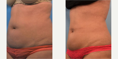 CoolSculpting before and after photo