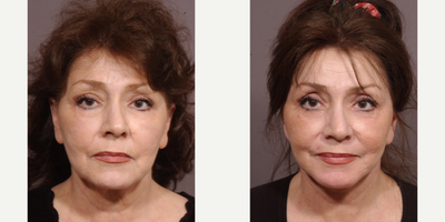Dermabrasion before and after photo