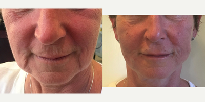 Restylane before and after photo