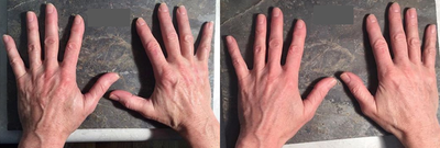 Dermal Fillers before and after photo