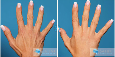 Dermal Fillers before and after photo