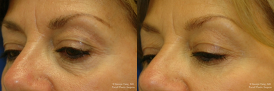 Eyelid Surgery before and after photo