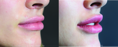 Juvederm before and after photo