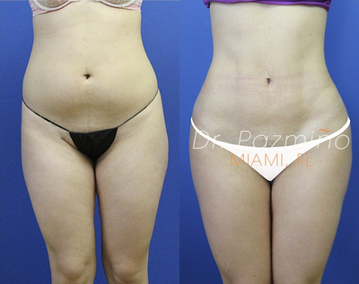 Liposculpture before and after photo