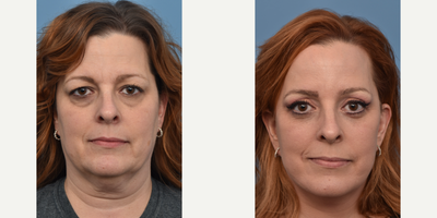 Mini Facelift before and after photo